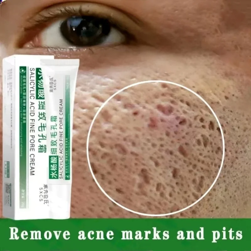 Azelaic Acid Cream - Salicylzuur Porie Clearing Cream Krimpen Poriën