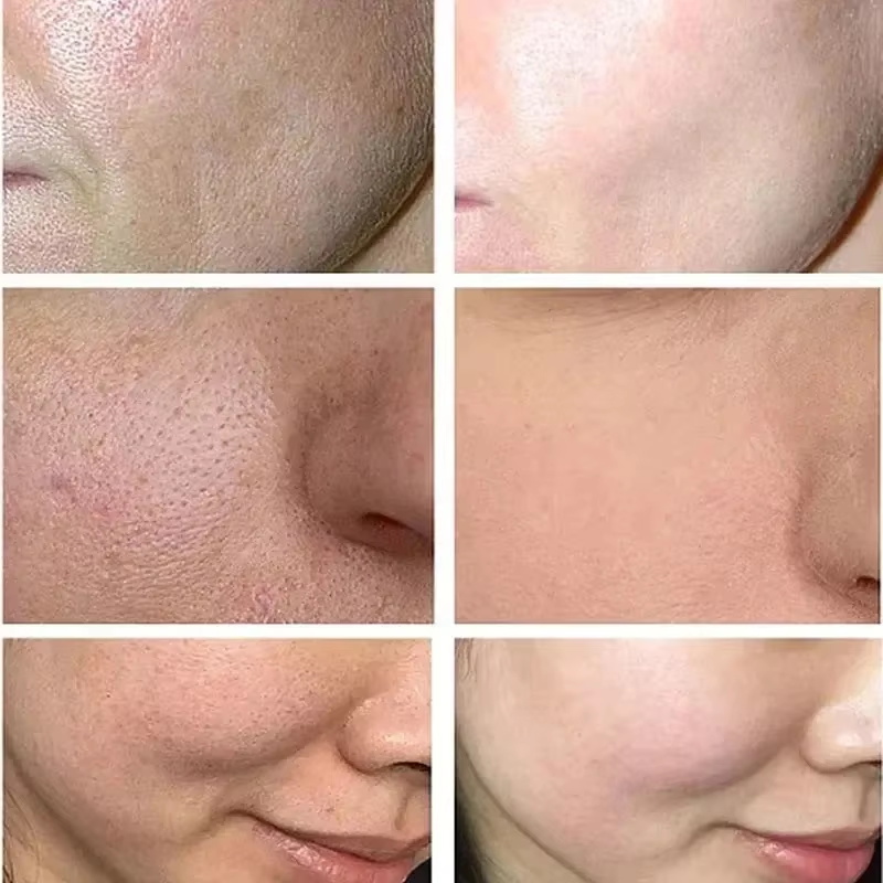 Salicylzuur poriënverfijnende  - Azelaic Acid Cream recensie en prijs