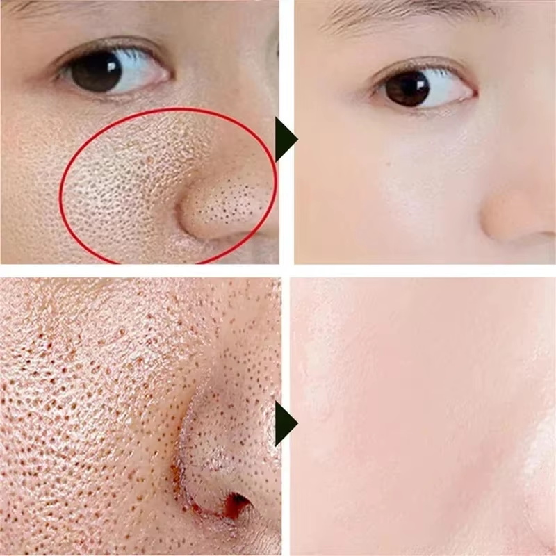Salicylzuur poriënverfijnende  - Azelaic Acid Cream recensie en prijs